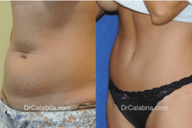 Tummy Tuck Scars  Renato Calabria MD FACS