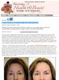 Article: The Stem Cell Face Lift