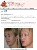 Article: What Is a Stem Cell Facelift