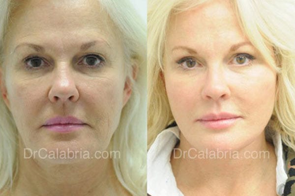 Facelift in Beverly Hills Before and After Picture of a real patient