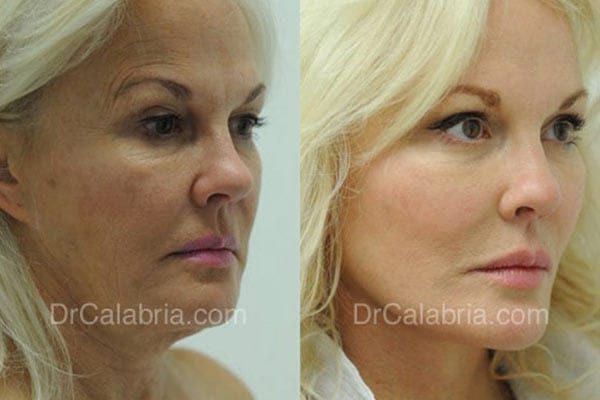 Beverly Hills Facelift Before and After Photo