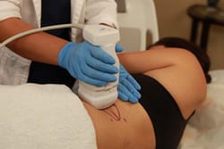 Woman getting LIPOSONIX treatment